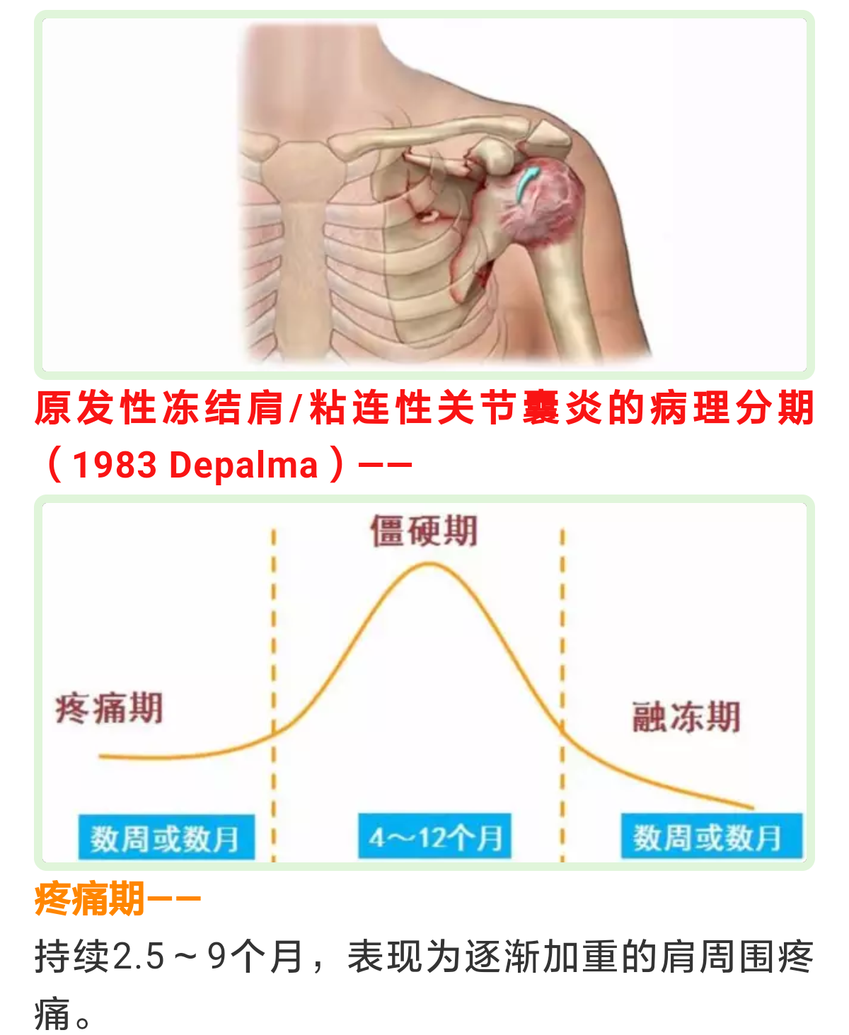 肩痛冻结肩俗称肩周炎诊治要点专业版