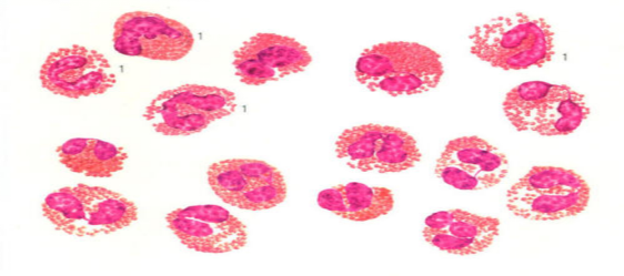 還有少見的血液病嗜酸粒細胞增多症時嗜酸粒細胞明顯增高;嗜鹼性粒