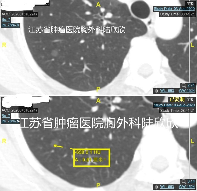 周永慧CT值水印.jpg