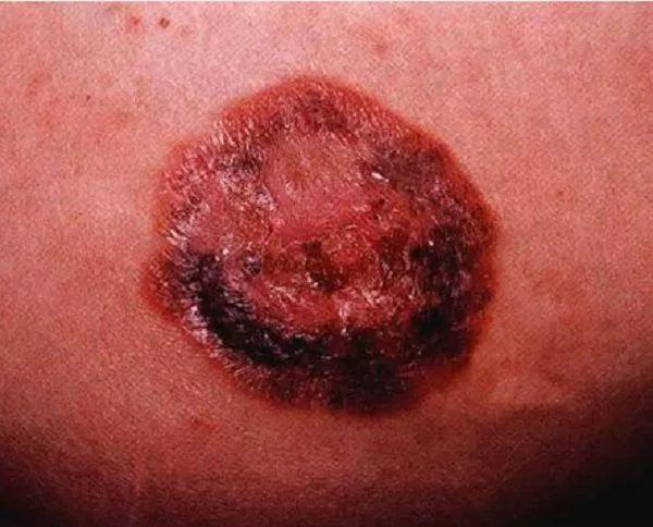 乳腺癌表皮早期图片图片
