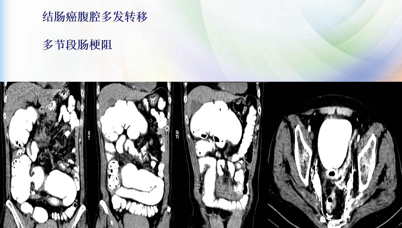 三亚广慈医院成功治愈一名84岁肠梗阻肠坏死老年病人