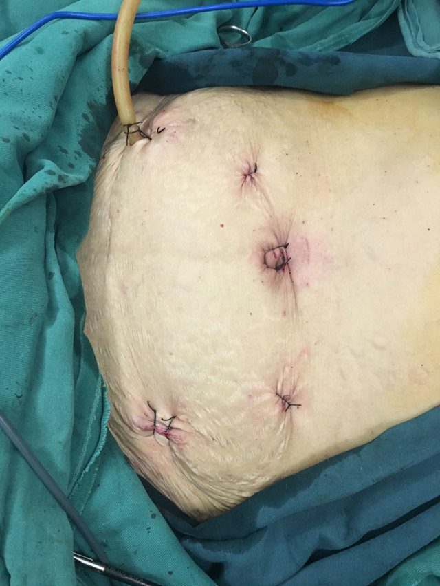 腹腔镜类notes手术,微创的微创 - 好大夫在线