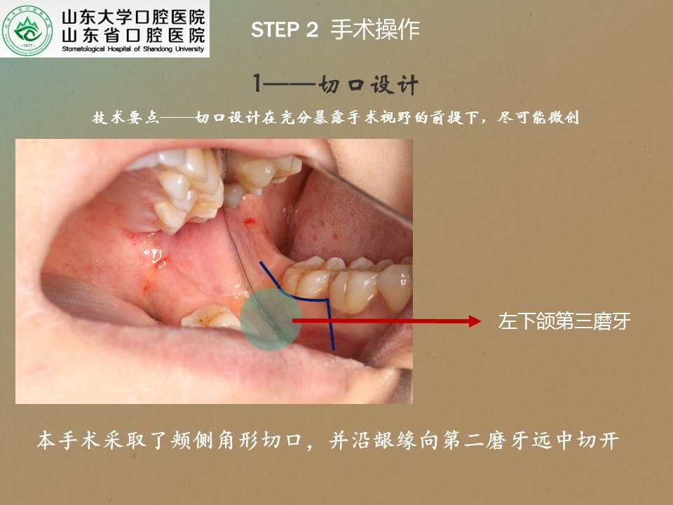 疑難複雜牙拔除系列1——第二磨牙根方的骨埋伏阻生牙