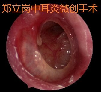 前言:中耳炎微創手術是目前治療慢性化膿性中耳炎及膽脂瘤型中耳炎最