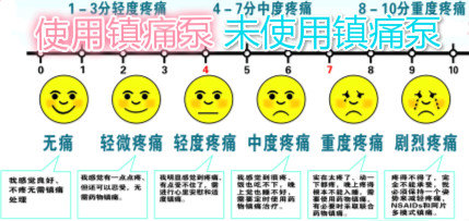 镇痛泵,你用过么?_剖腹产_用药_治疗方式 - 好大夫在线