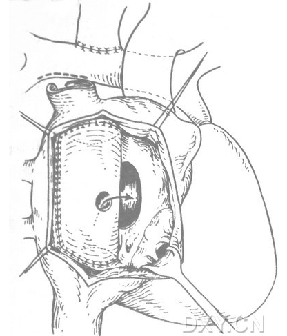 2018年1月16日,先天性心脏病外科大师francis fontan