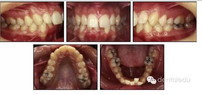 一例年輕成人上頜牙弓狹窄擴弓後22年