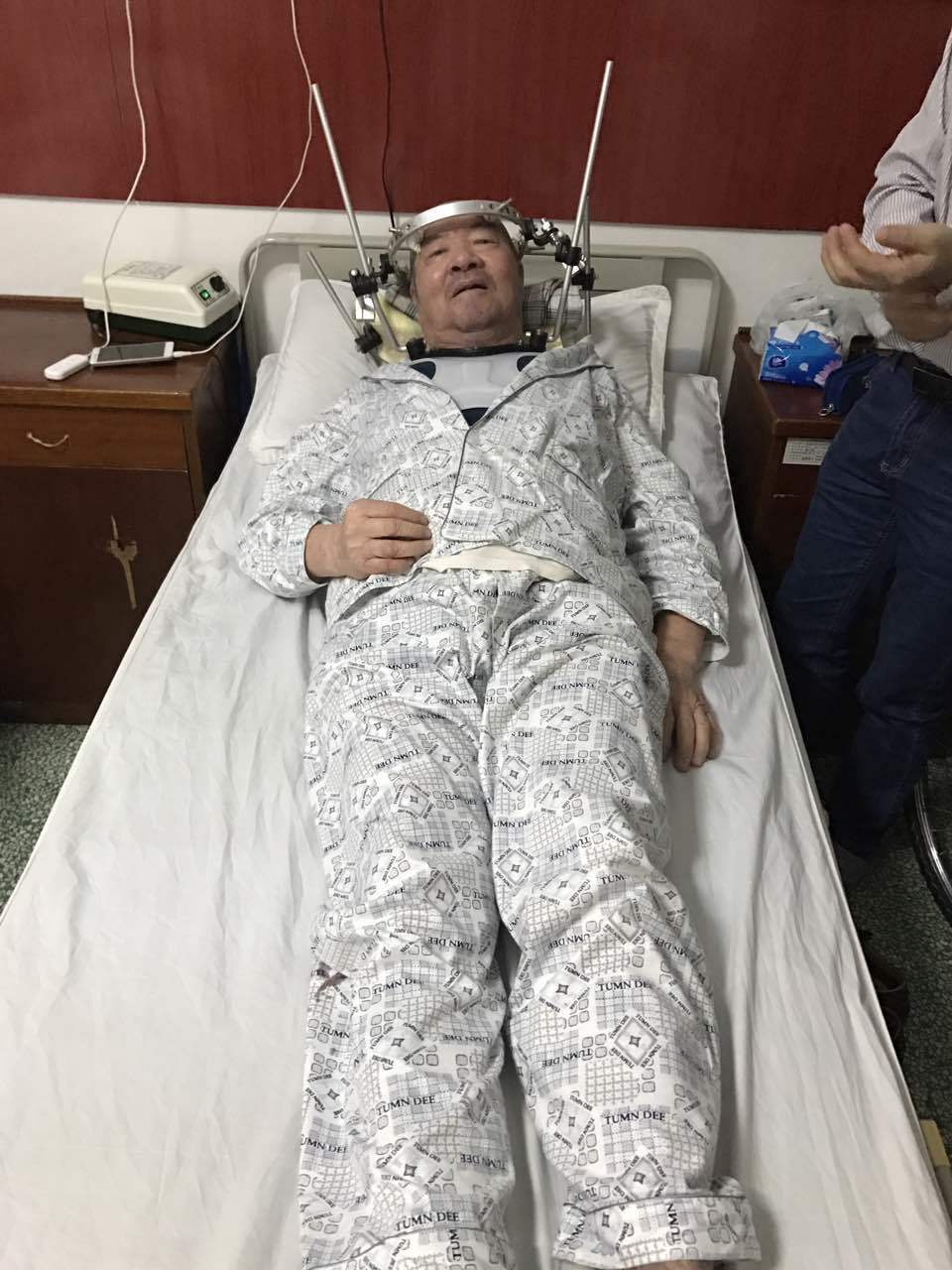 哈罗氏架是一个稳定的外固定器材,是一项个性化治疗手段,适用于不伴有