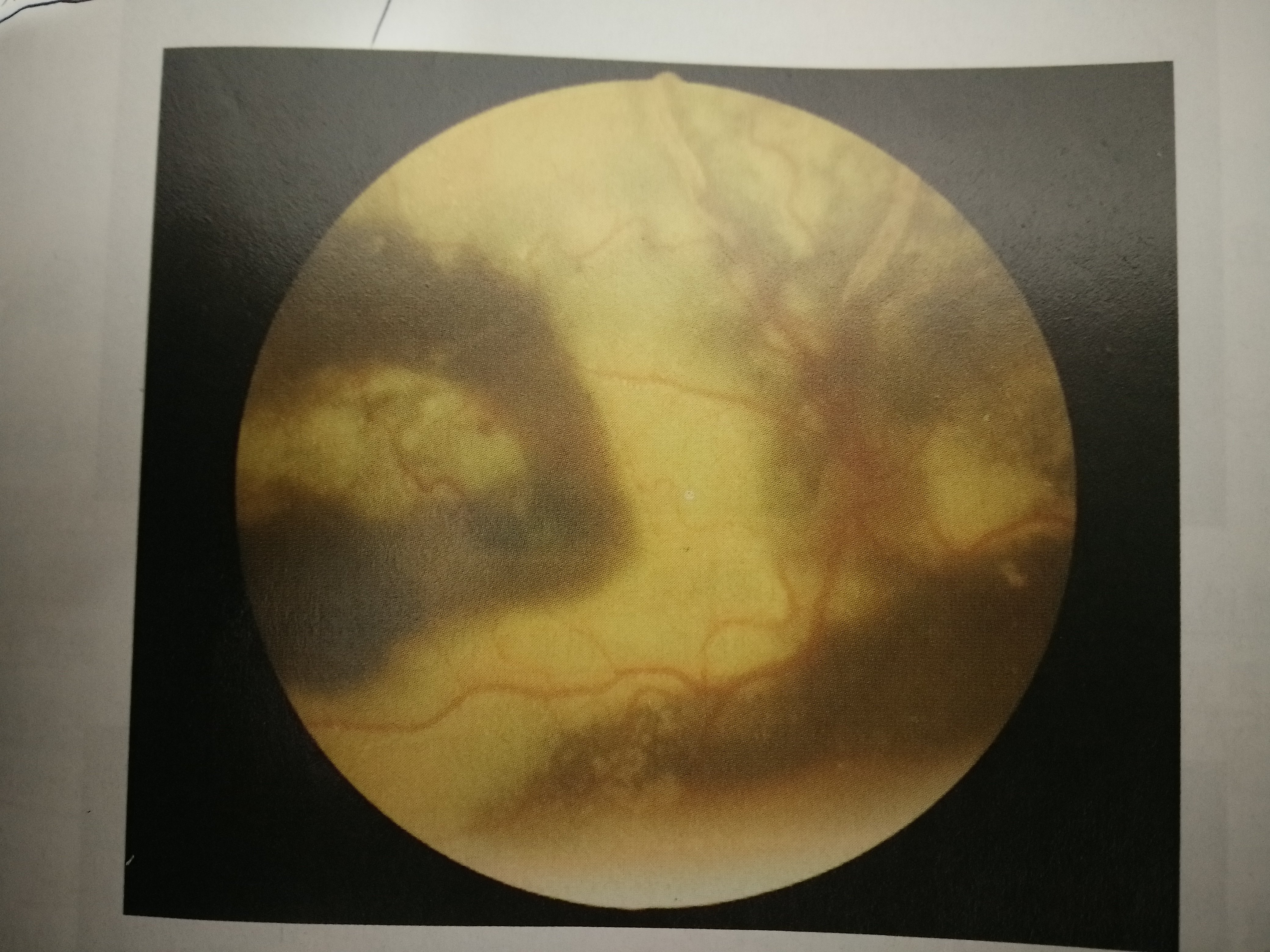 眼科陈剑医生教您认识coats病