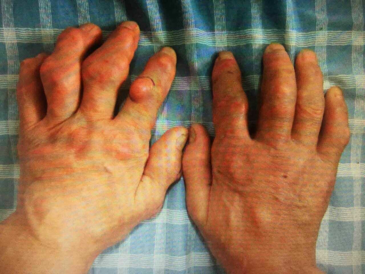 手指尿酸结晶初期图片图片