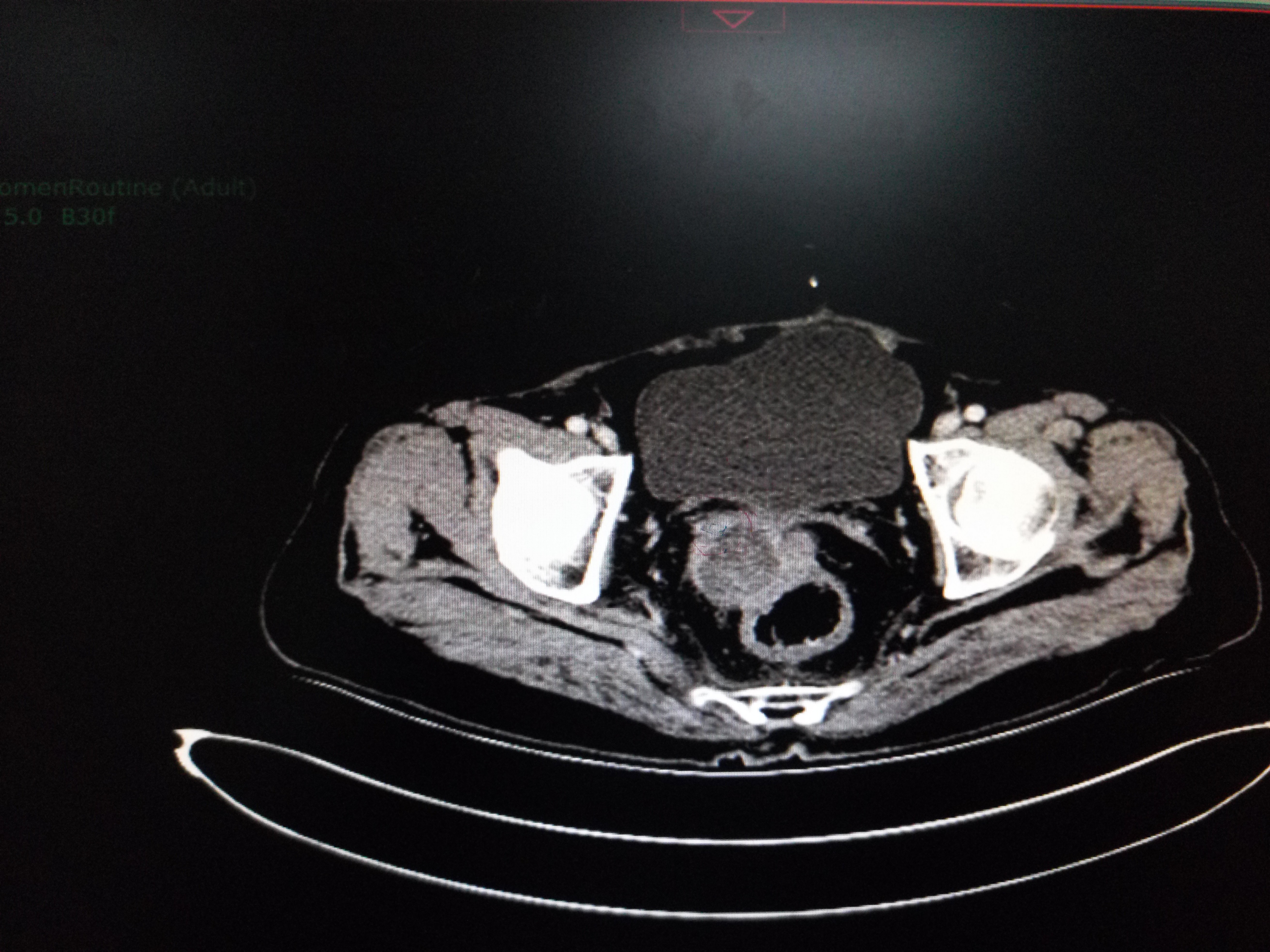 病人目前,也就是二次手术后14个月磁共振图像病人70岁,一般情况好.