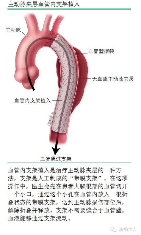主动脉夹层手术步骤图图片