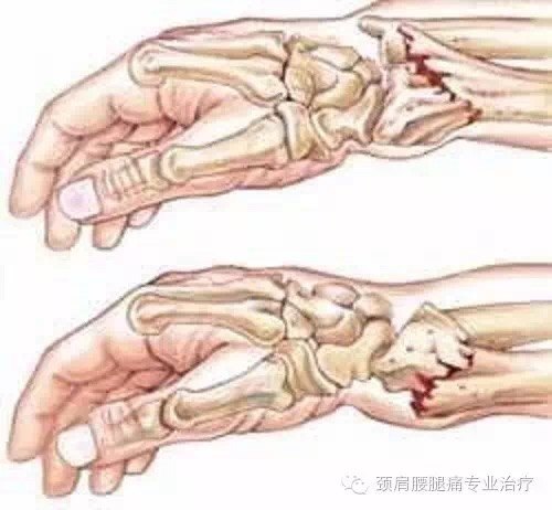 Colles骨折 Colles骨折