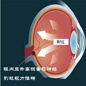 眼压与近视角膜矫正手术的关系