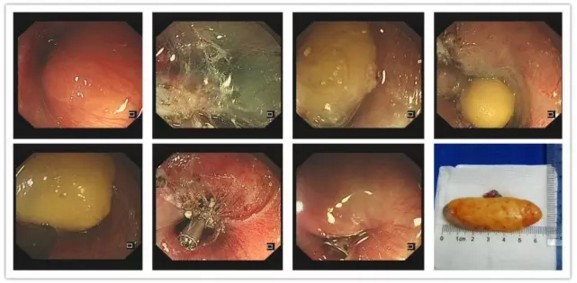 5cm*7cm的 食管巨大 脂肪瘤 .