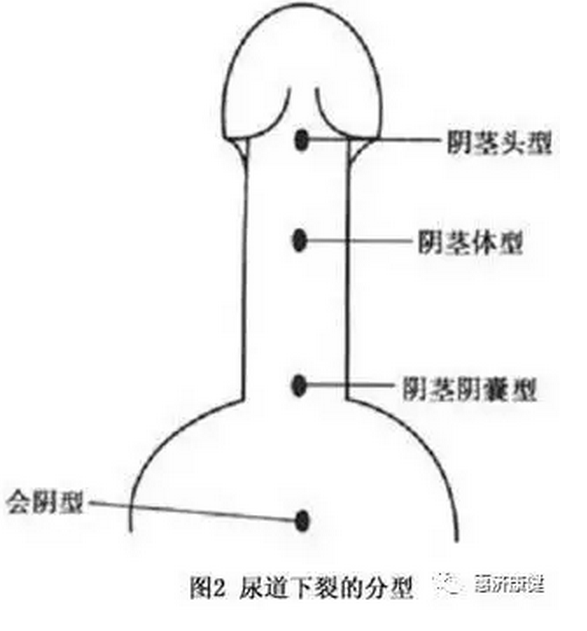 尿道下裂的治疗由于尿道下裂患儿尿道口位置不正常,阴茎弯曲,不能正常