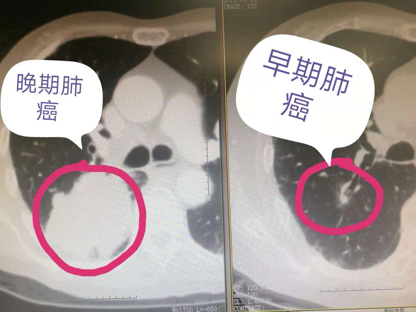 左图为晚期肺癌,右图为早期肺癌(5年前)但是天不遂人愿,半年后,一次
