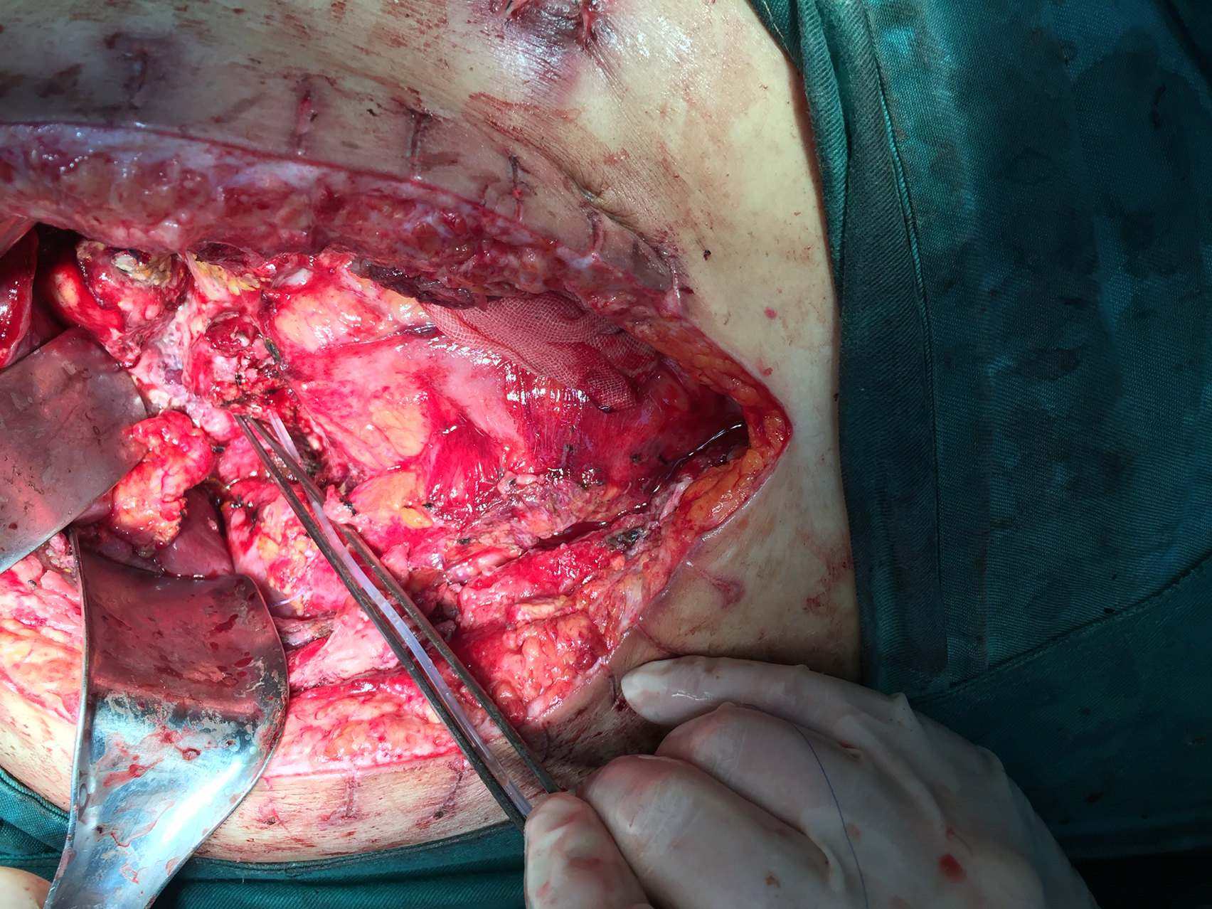 胰头癌切除后胰漏出血非计划性再手术新方式成功 - 好大夫在线