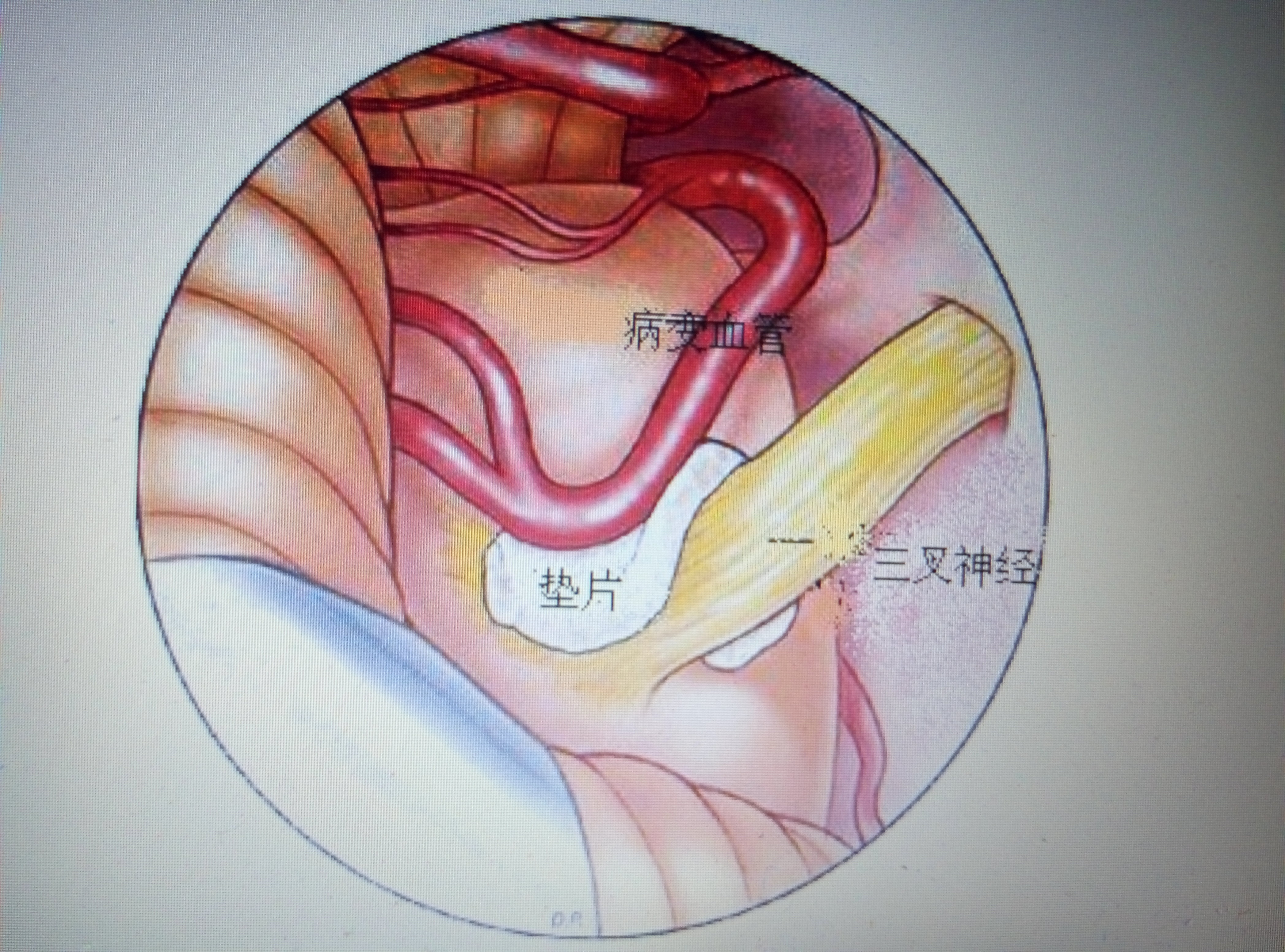 神奇的显微血管减压术(mvd) - 好大夫在线