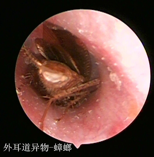 漫谈外耳道异物