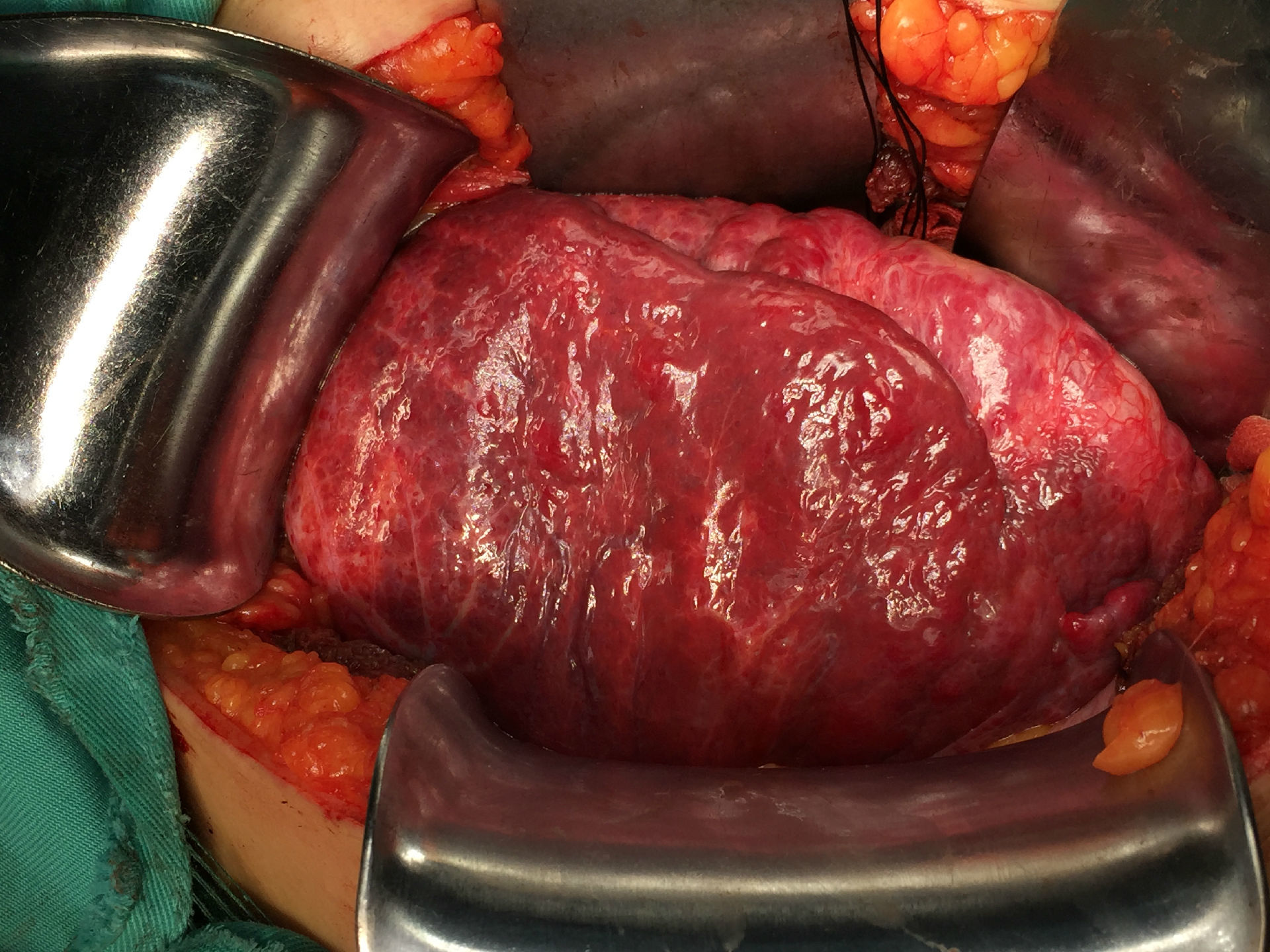 肝脏巨大血管瘤30cm侵犯肝门无法切除形肝a结扎
