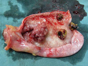 胆囊切除如果有必要还是手术好