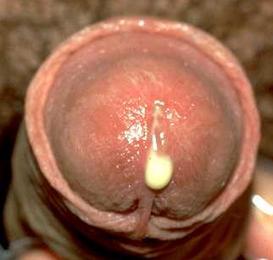 尿道口流脓会是什么病?