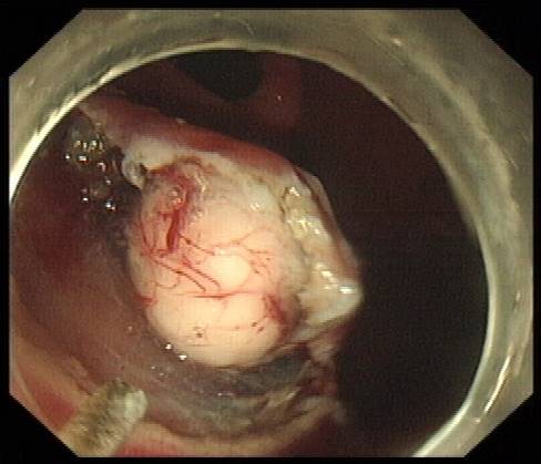 近期胃黏膜下肿瘤治疗病例