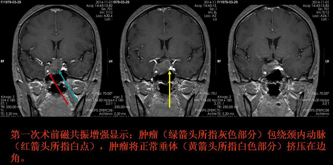 磁共振顯示腫瘤復發,患者曾諮詢北京及上海的國內有名的垂體瘤專家,均