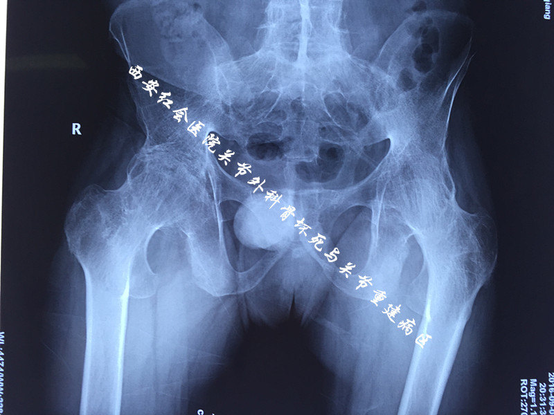 原创 红会医院成功救助25岁"强直性脊柱炎"帅小伙