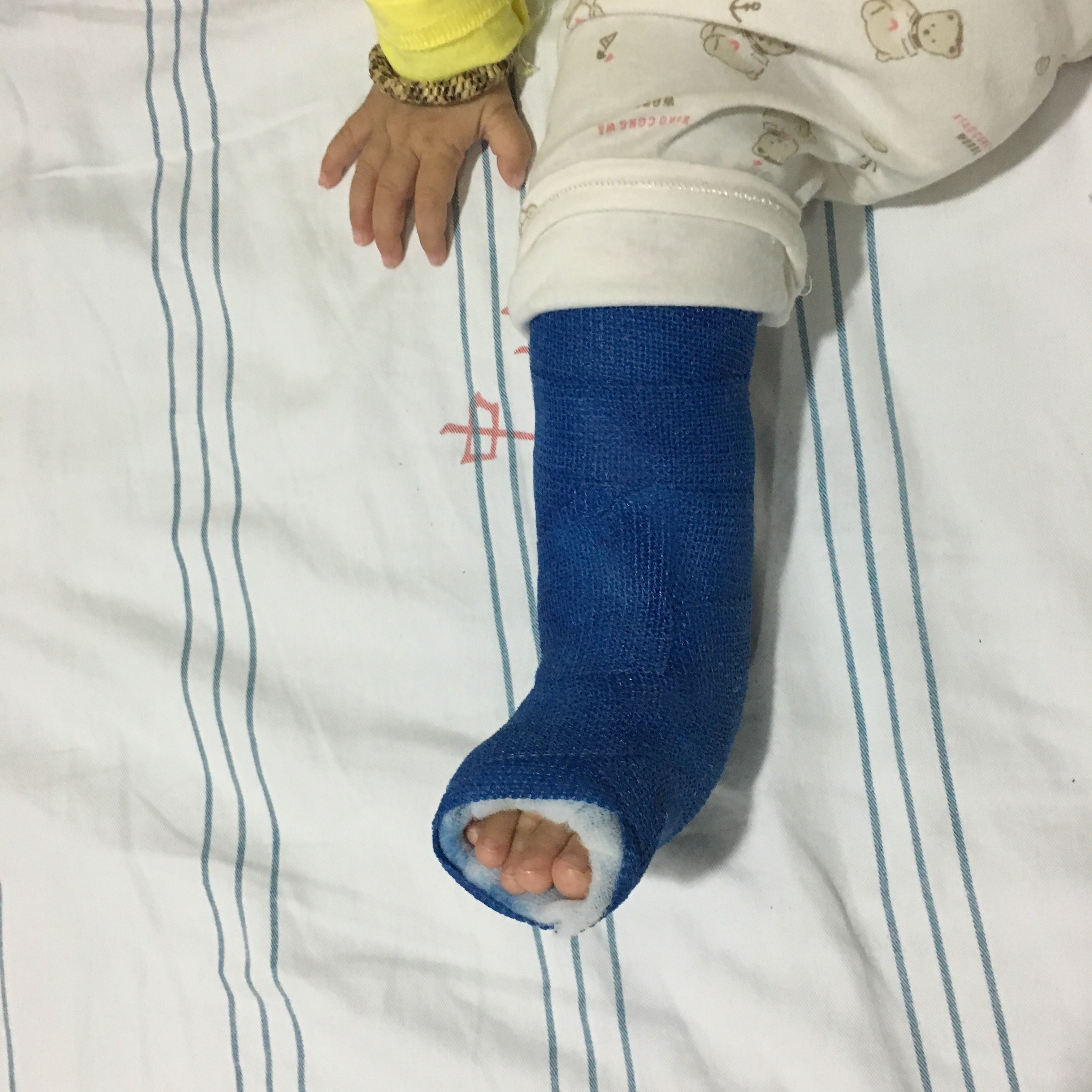 马蹄内翻足早治效果好 - 好大夫在线