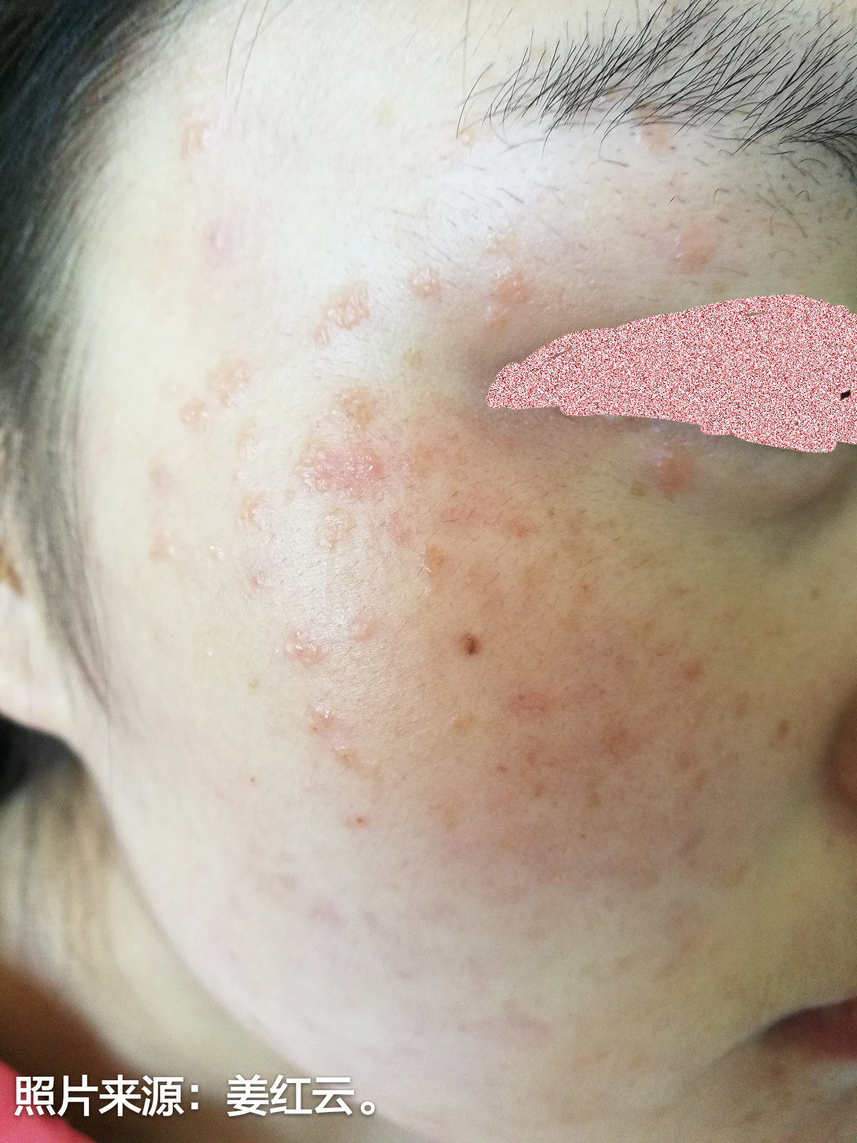 损容性皮肤病 --- 扁平疣