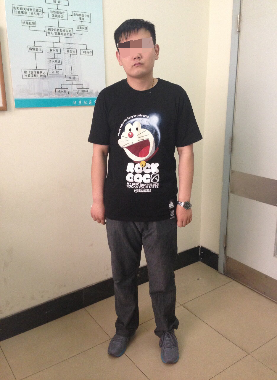 袖状胃切除术减肥手术介绍(之二)