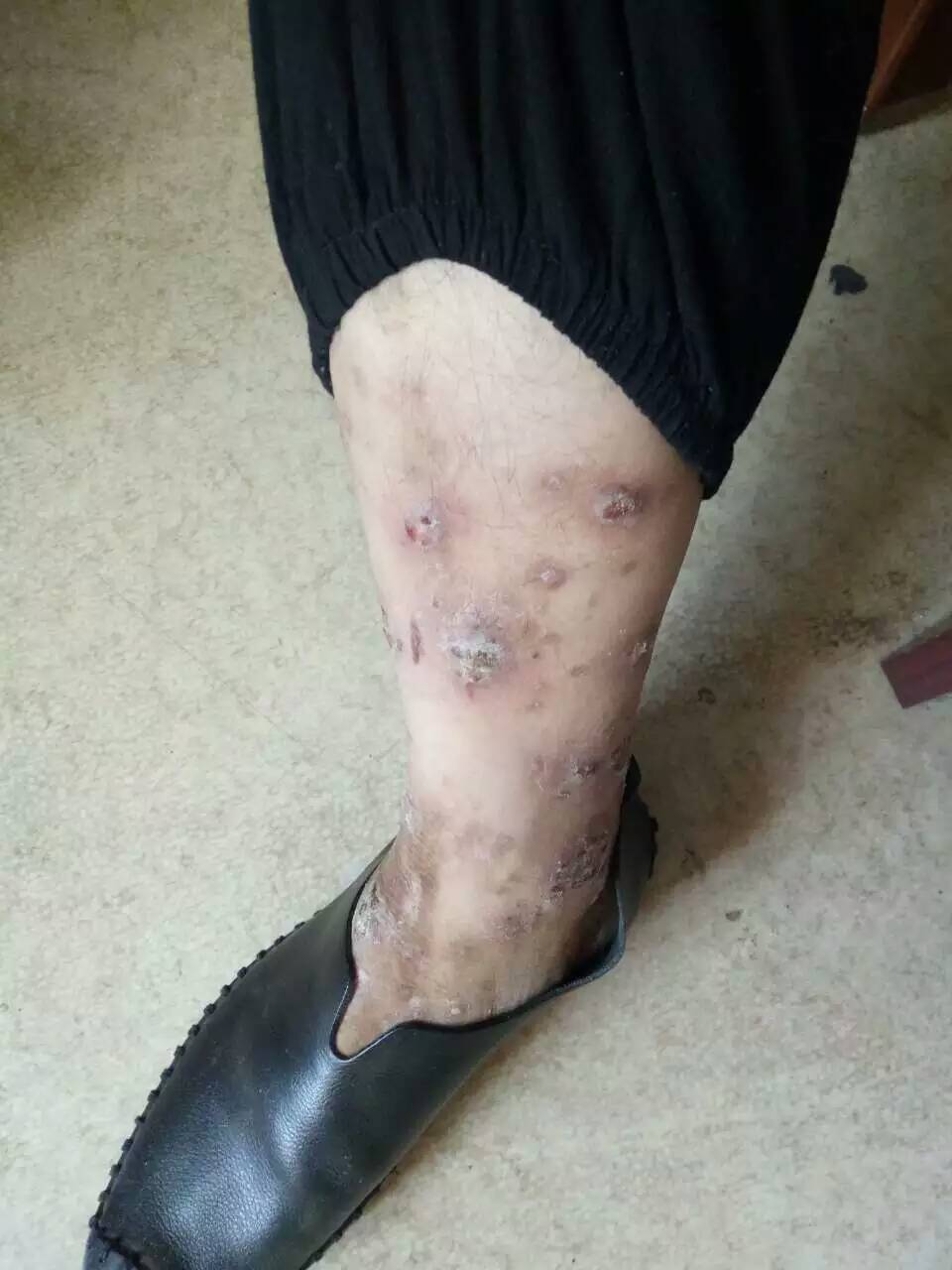 中医治疗顽固性湿疹1例