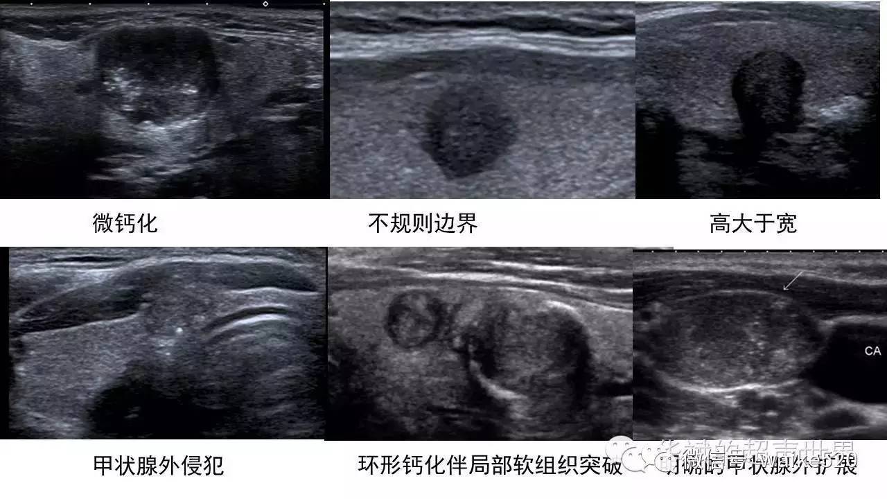 2015版ata成人甲状腺结节和分化型甲状腺癌超声解读