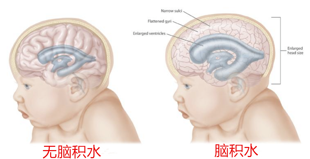 落日目脑积水图片