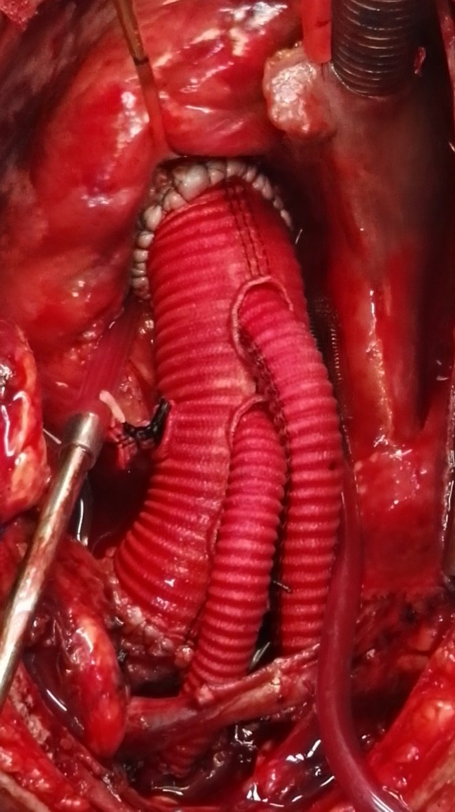 主动脉夹层手术方式图片