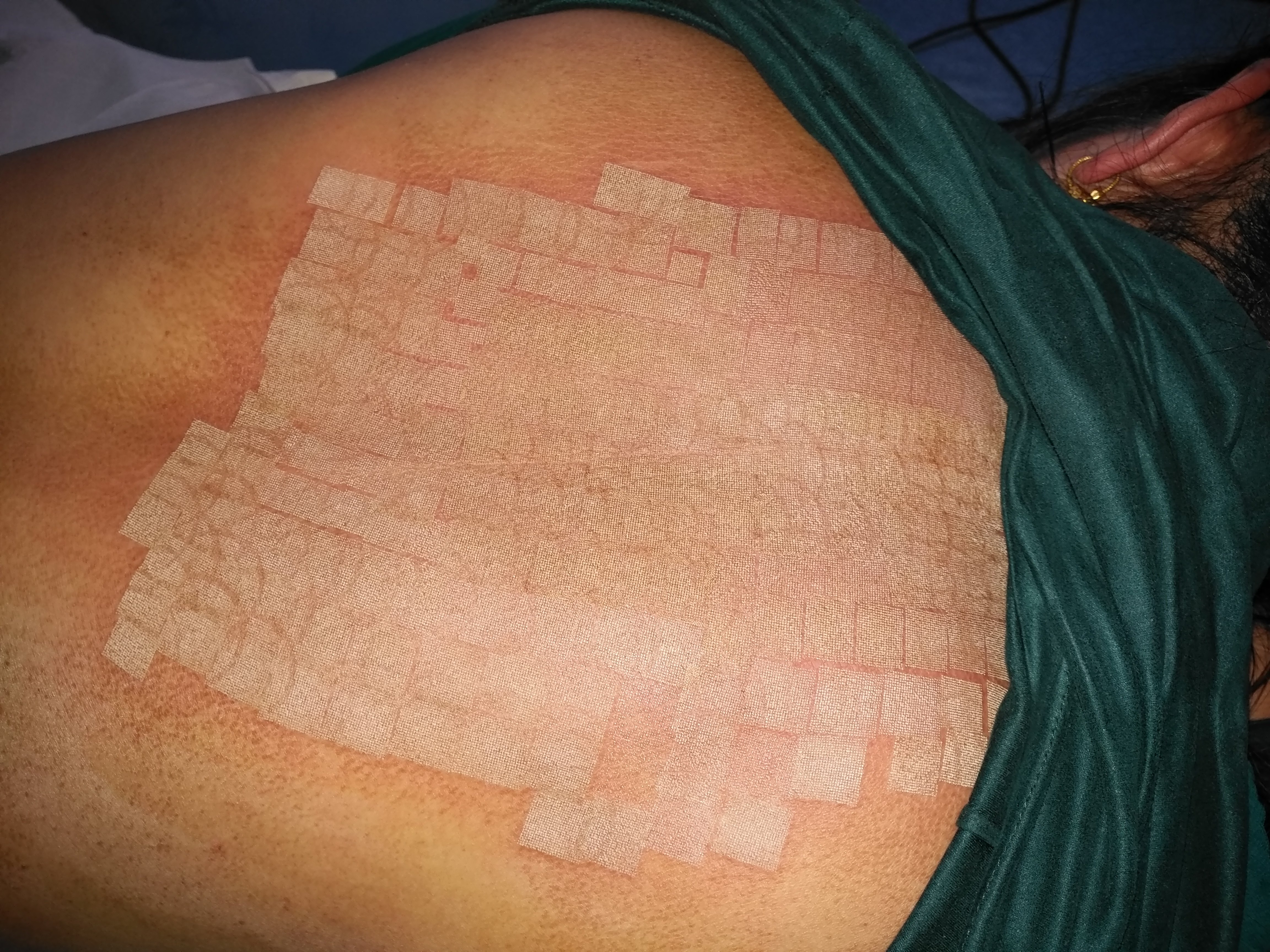 超脉冲二氧化碳点阵激光在淀粉样变病治疗上的应用