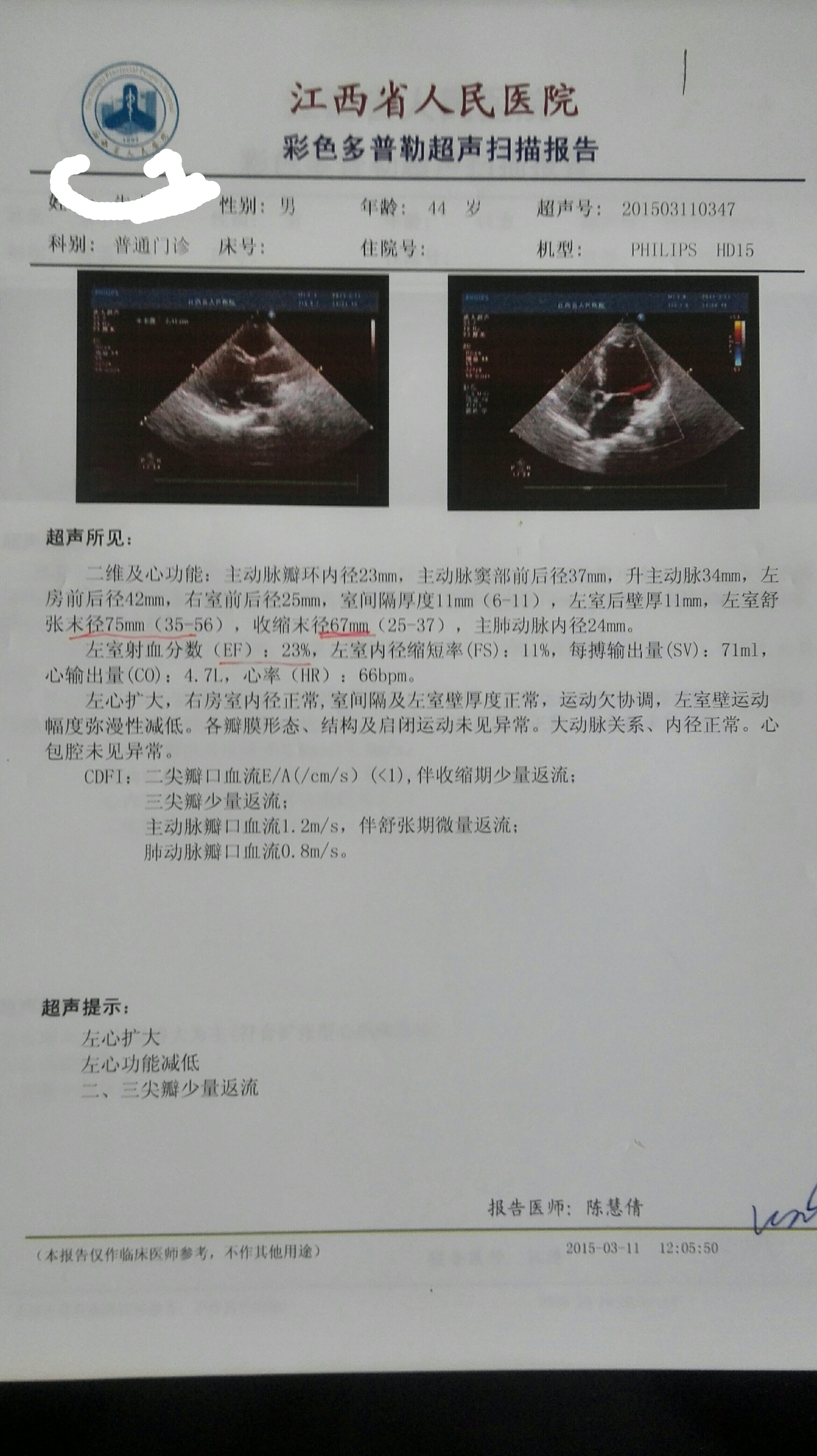 扩张型心肌病 心力衰竭