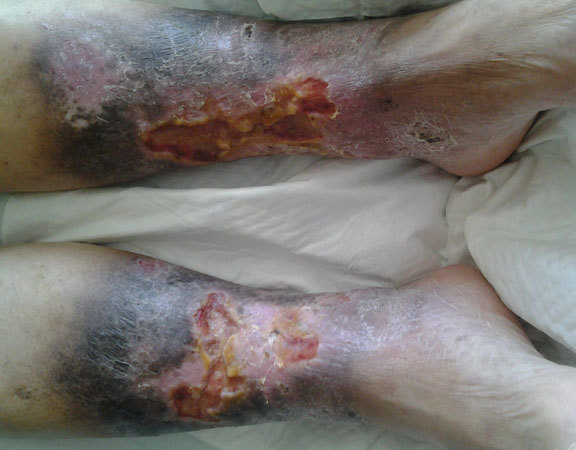 老烂腿有办法治愈