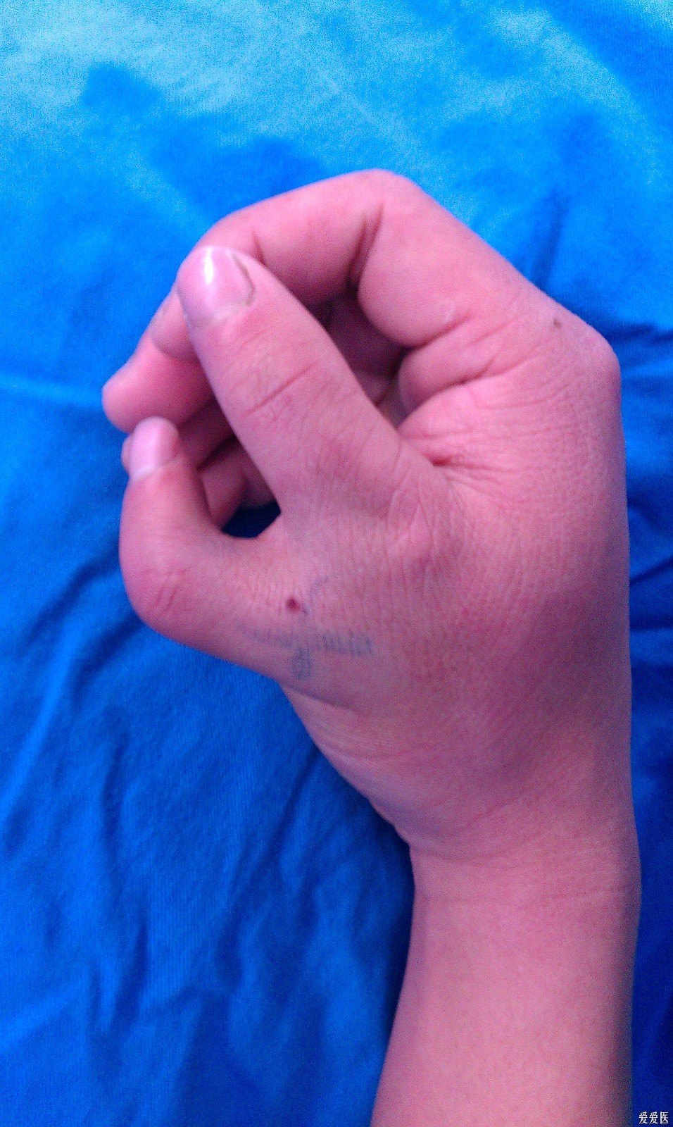 小儿六指畸形的类别和治疗方法? 