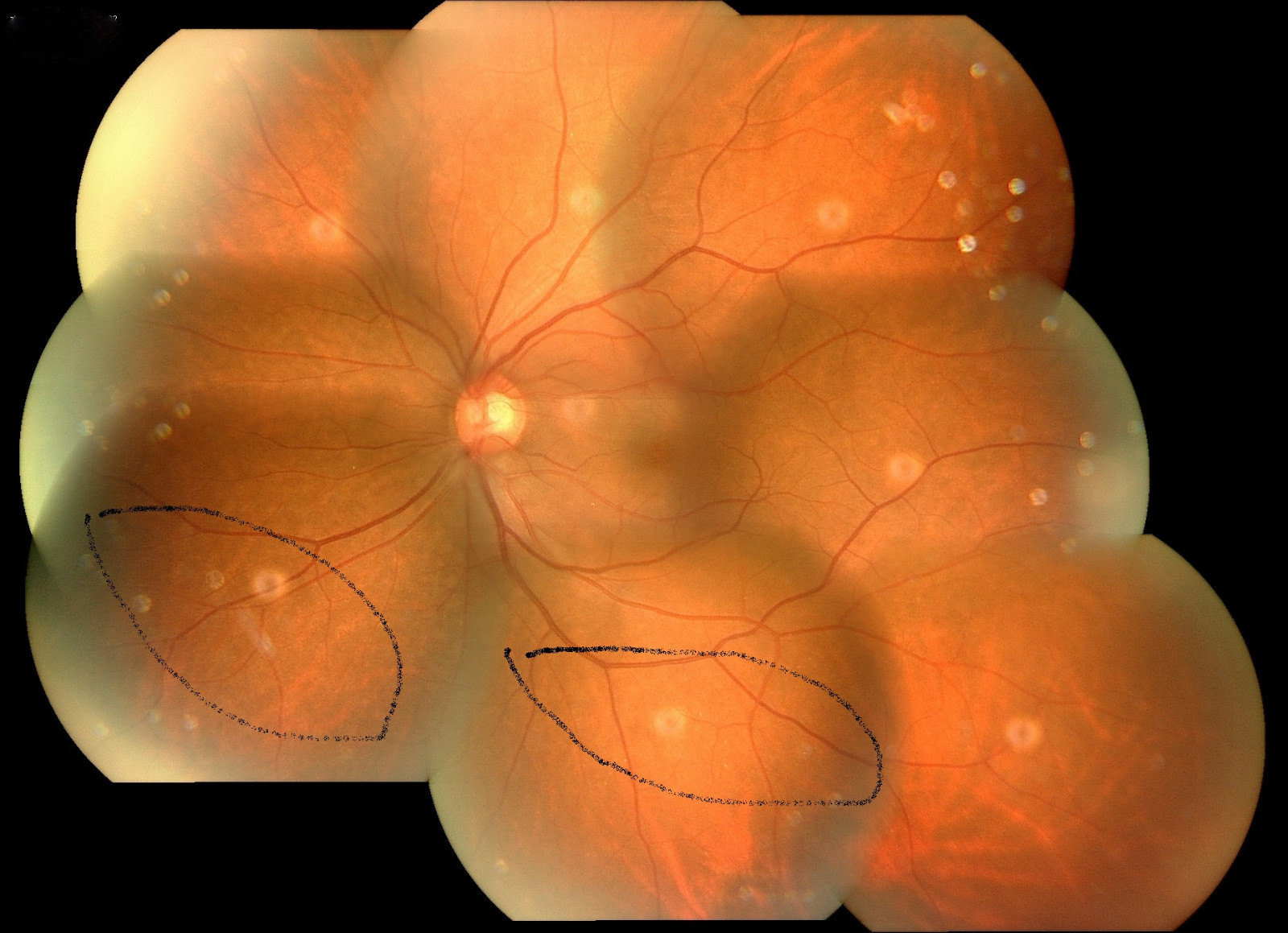 典型病例一孔源性视网膜脱离手术一例