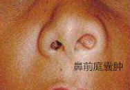 鼻前庭囊肿图图片