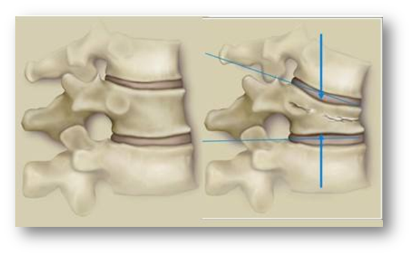 椎体压缩性骨折分度图图片