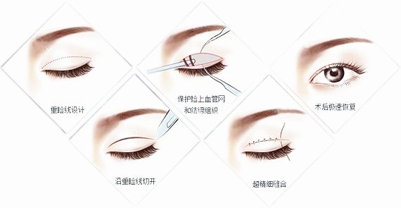 内双可以做全切双眼皮么