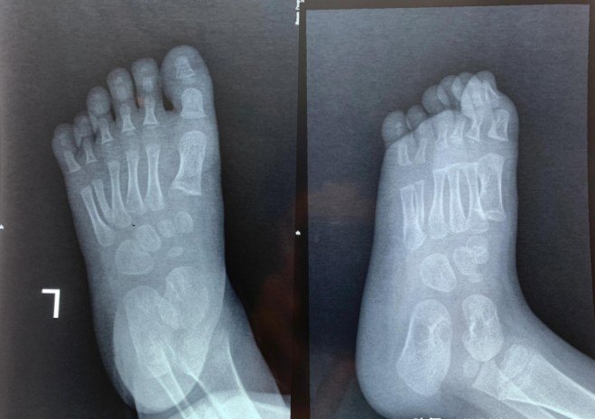 脚趾多趾畸形手术案例多趾畸形的治疗案例