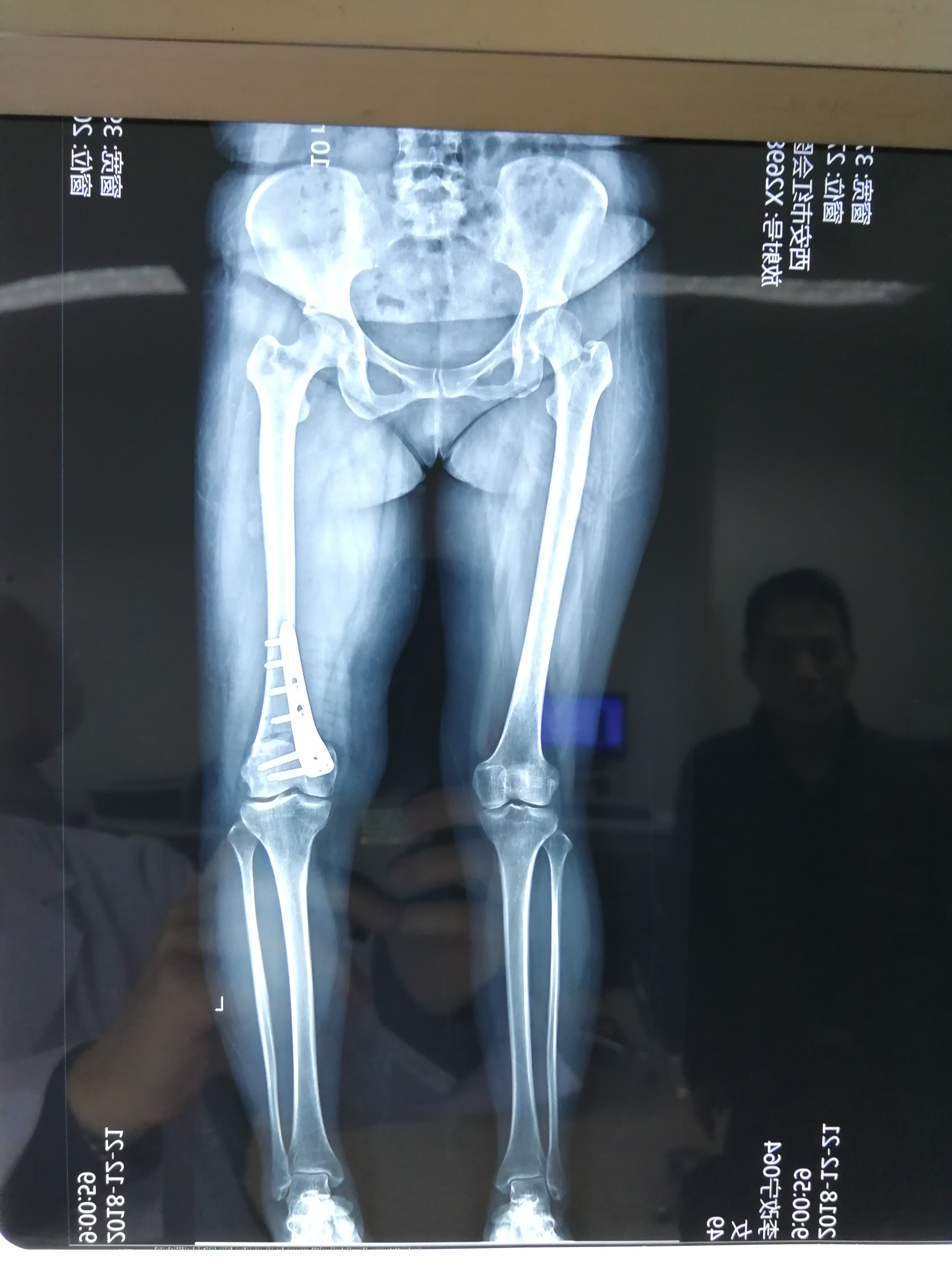 x形腿通过截骨矫形手术可完全变直 - 好大夫在线