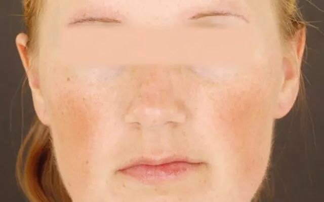 面部萎缩性毛发角化病 (转载)