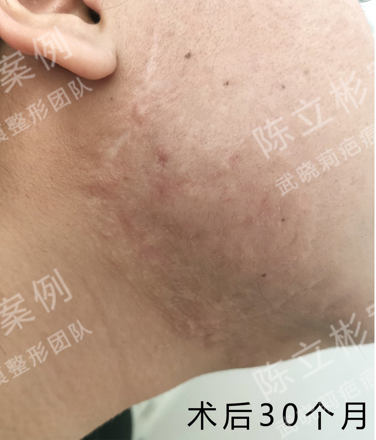 下颌疤痕疙瘩术后30个月复诊记录