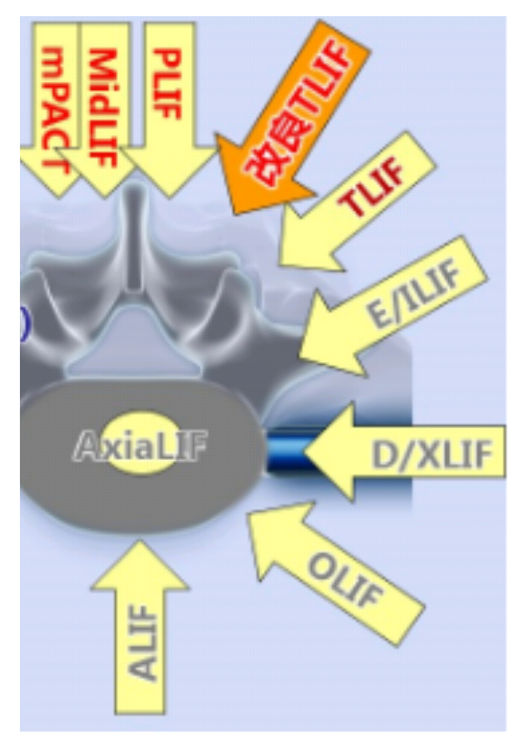 常见脊柱手术英文缩写 好大夫在线 常见脊柱手术英文缩写 好大夫在线